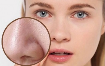 Làm sao để giảm thiểu sợi bã nhờn trên da vào mùa hè?