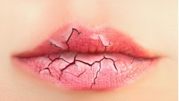 7 cách trị môi khô nứt nẻ, bong tróc cực đơn giản tại nhà