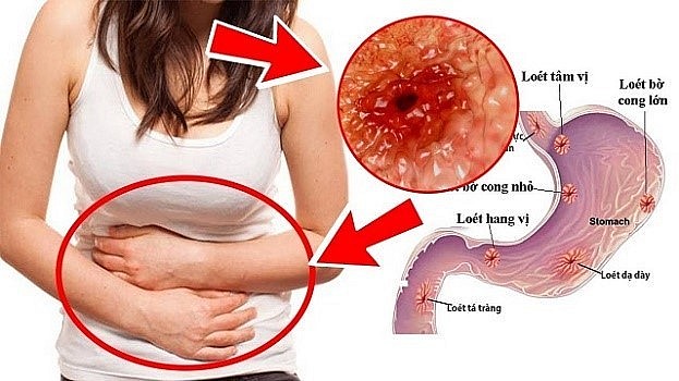 Cây mộc hương hỗ trợ điều trị viêm dạ dày mạn tính