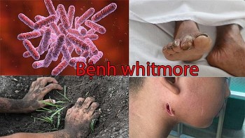 Cách phòng bệnh Whitmore khi chưa có vaccine