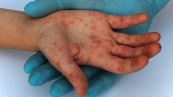 Ghi nhận ca bệnh đậu mùa khỉ đầu tiên ở Đồng Nai, chưa rõ nguồn lây