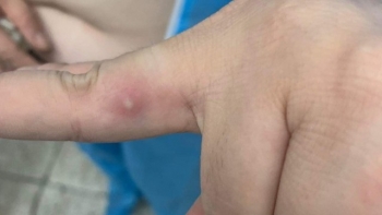 Theo dõi sức khoẻ 8 người tiếp xúc gần với bệnh nhân đậu mùa khỉ