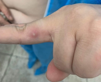 Theo dõi sức khoẻ 8 người tiếp xúc gần với bệnh nhân đậu mùa khỉ