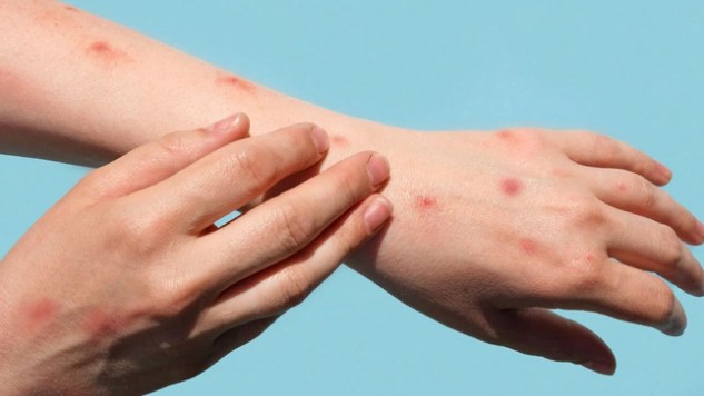 Những điều cần biết để tránh bị lây đậu mùa khỉ