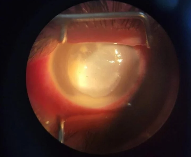 Hình ảnh tổn thương mắt của nữ bệnh nhân sau khi tự ý dùng thuốc khi bị đau mắt đỏ. (Ảnh: BS Nguyễn Duy Bích