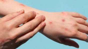 TP.HCM ghi nhận ca đậu mùa khỉ thứ 5 ở quận Tân Bình