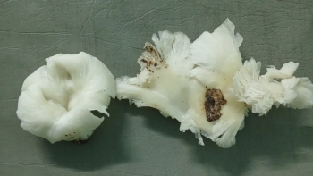 Sau khi ăn nấm lạ, ba người lên cơn co giật, trụy tim mạch