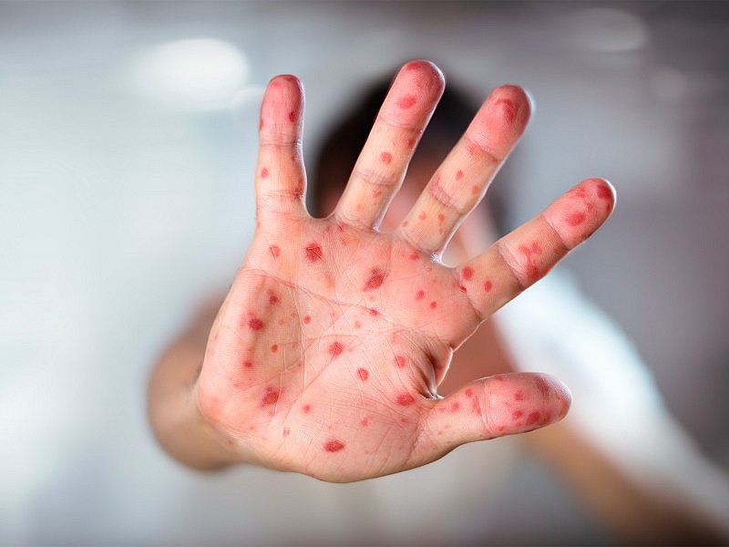 Virus sởi có khả năng lưu lại trong không khí và trên bề mặt trong thời gian dài. Virus sởi có khả năng lưu lại trong không khí và trên bề mặt trong thời gian dài.
