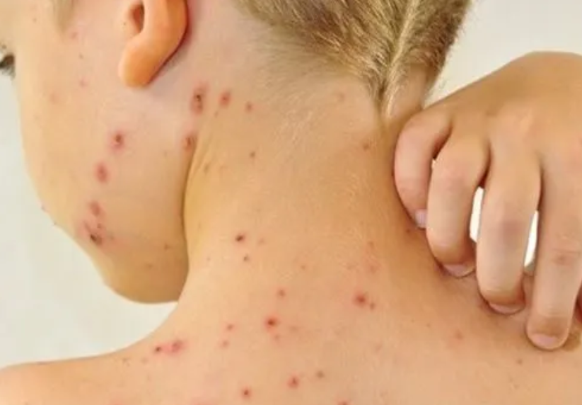 Làm gì để phòng các bệnh về da trong mùa nắng nóng? Làm gì để phòng các bệnh về da trong mùa nắng nóng?