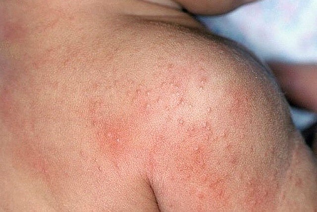 Làm gì để phòng các bệnh về da trong mùa nắng nóng? Làm gì để phòng các bệnh về da trong mùa nắng nóng?