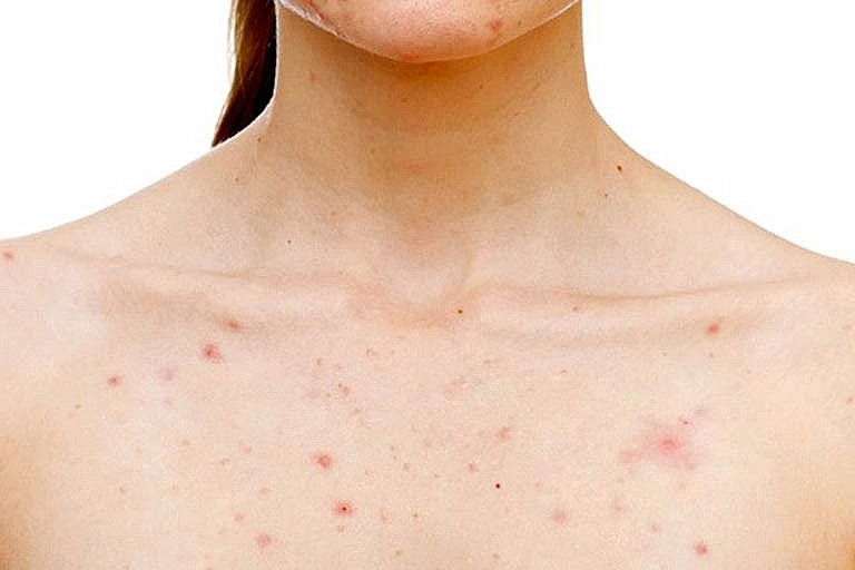 Làm gì để phòng các bệnh về da trong mùa nắng nóng? Làm gì để phòng các bệnh về da trong mùa nắng nóng?