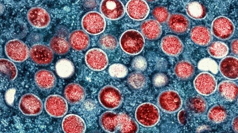 Phát hiện dạng đậu mùa khỉ mới dễ lây, tỷ lệ tử vong cao