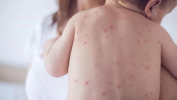 Biến chứng nguy hiểm của bệnh thủy đậu