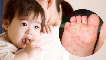Số ca sốt xuất huyết giảm, tay chân miệng tăng