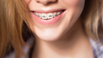 Kiêng ăn gì sau khi niềng răng