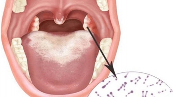 Bệnh bạch hầu lây truyền thế nào?