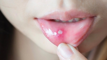 Khi bị nhiệt miệng nên kiêng những gì?