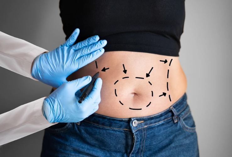 Phẫu thuật hút mỡ và các biến chứng nguy hiểm tính mạng có thể gặp