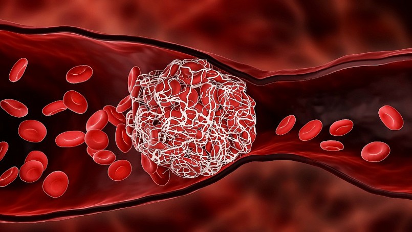 Tại sao đột quỵ lại thường xảy ra vào mùa lạnh?