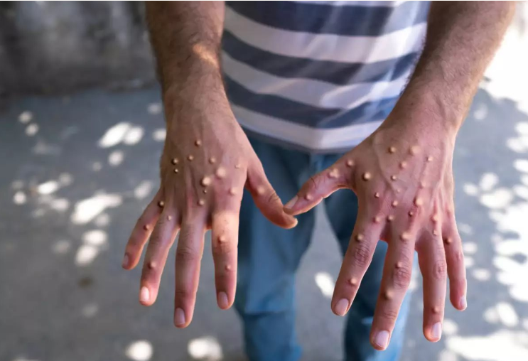 Người mắc đậu mùa khỉ thường xuất hiện những nốt mụn nước trên da. Người mắc đậu mùa khỉ thường xuất hiện những nốt mụn nước trên da.