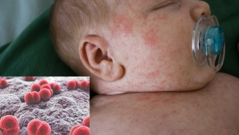 Ai dễ mắc viêm màng não mô cầu?