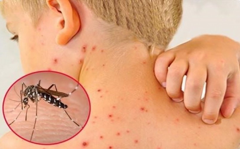 Cảnh báo trẻ sốc sốt xuất huyết nặng dù chưa vào mùa dịch Cảnh báo trẻ sốc sốt xuất huyết nặng dù chưa vào mùa dịch