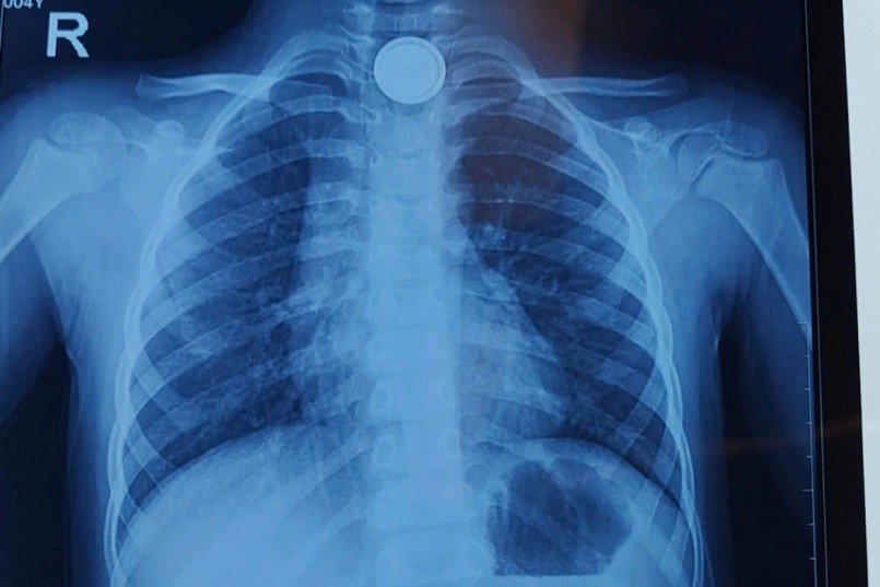 Vị trí pin cúc áo trong cổ bệnh nhi (Ảnh: Bệnh viện cung cấp). Vị trí pin cúc áo trong cổ bệnh nhi (Ảnh: Bệnh viện cung cấp).