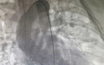 Hội chứng "trái tim tan vỡ" xuất hiện ở người phụ nữ sau khi bị chấn thương sọ não