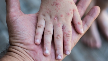 Nguyên nhân khiến dịch sởi lan rộng