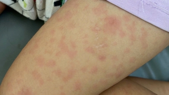 Bộ Y tế tăng cường kiểm tra công tác phòng, chống dịch sởi tại thành phố Đà Nẵng