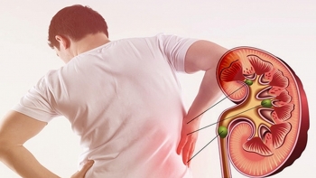 Dấu hiệu của bệnh sỏi thận