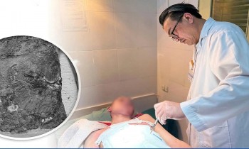 Đắp thuốc nam chữa bỏng, bé trai 14 tuổi nhập viện trong tình trạng hoại tử nặng