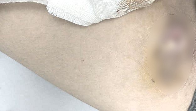 Tổn thương loét hoại tử mô, cơ vùng bẹn trái trước điều trị đa kháng sinh. Ảnh BVCC