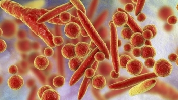 Bộ Y tế thông tin về bệnh ho ra máu tại Nga