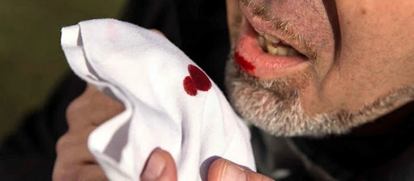 Bộ Y tế thông tin về bệnh ho ra máu tại Nga Bộ Y tế thông tin về bệnh ho ra máu tại Nga