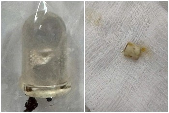 Đèn LED và tẩy bút chì mắc kẹt ở phế quản và mũi của bé 6 tuổi