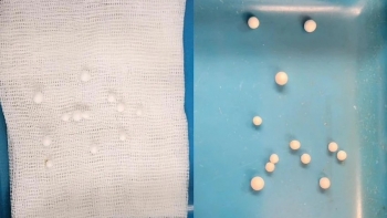 Bé trai viêm xoang mủ, bác sĩ gắp ra "cả tá" dị vật trong mũi