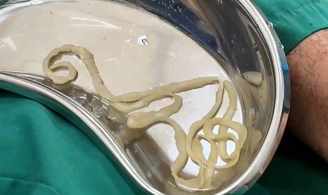 Con sán dây dài 1 mét được lấy ra khỏi người bệnh nhân  ẢNH: BSCC