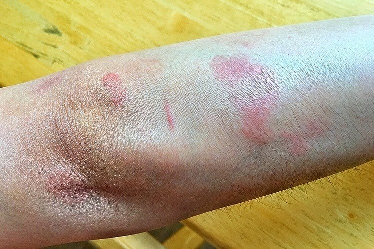 lupus ban đỏ. (Ảnh minh họa) lupus ban đỏ. (Ảnh minh họa)