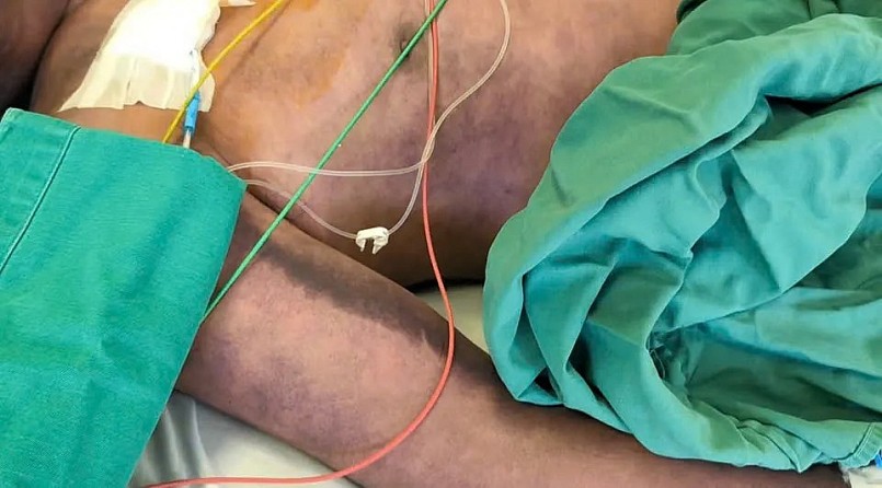 Bệnh nhân nhập viện trong tình trạng ban xuất huyết hoại tử lan rộng toàn thân, đặc biệt ở vùng mặt và tứ chi. Ảnh: BVCC