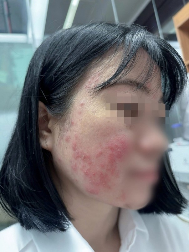 Phần da mặt bị tổn thương của nữ bệnh nhân. Ảnh: BSCC