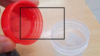 Đau nhức mắt kéo dài, người phụ nữ đi khám thì tá hỏa phát hiện ký sinh trùng trong mắt