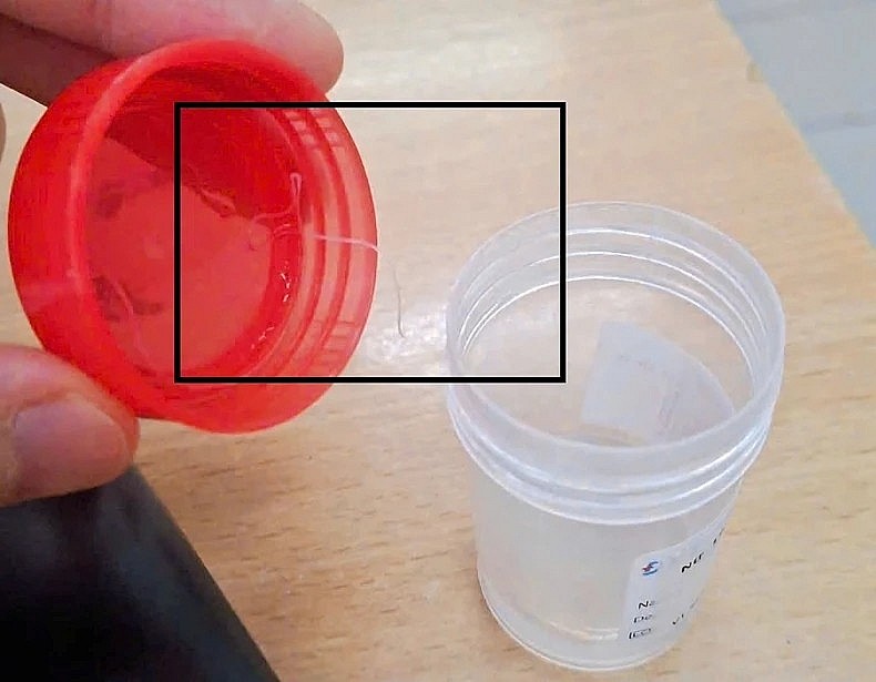 Hình ảnh ký sinh trùng được lấy ra từ mắt bệnh nhân. Ảnh: BVCC