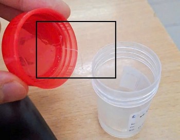 Đau nhức mắt kéo dài, người phụ nữ đi khám thì tá hỏa phát hiện ký sinh trùng trong mắt