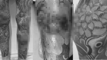 Nam thanh niên nhập viện vì dị ứng gây ngứa ngáy sau khi xăm