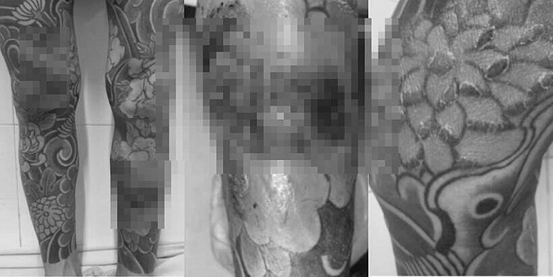 Hình ảnh viêm da tiếp xúc dị ứng do dị ứng mực xăm, có bội nhiễm sau khi xăm nghệ thuật. Ảnh: BVCC