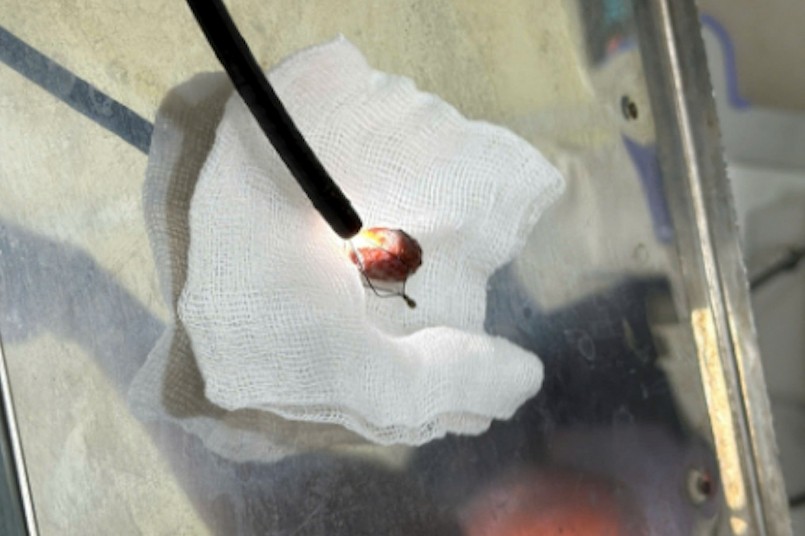 Dị vật sau khi được lấy ra khỏi cơ thể bệnh nhân (Ảnh: BV).