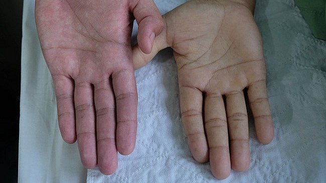 Thiếu máu làm giảm lượng oxy đến da, khiến da mất đi vẻ hồng hào tự nhiên.