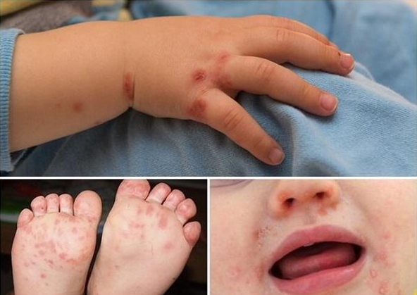 Dịch sởi chưa giảm nhiệt, ca sốt xuất huyết và tay chân miệng gia tăng Dịch sởi chưa giảm nhiệt, ca sốt xuất huyết và tay chân miệng gia tăng