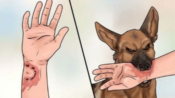 Cảnh báo nguy cơ gia tăng bệnh dại trong mùa hè